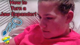 HOW TO TURN A BRACES JAW EXPANDER [upl. by Germana]