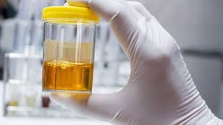 Things Found in Urine uti [upl. by Aicirpac549]