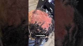 Sensitive Scalp Transformation 😱 [upl. by Hares93]