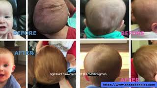 Infant Flat Head Treatment Helmet For Infant Head Shaping UK [upl. by Orran]