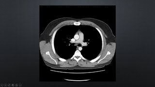 Tomografía de Tórax [upl. by Essy]