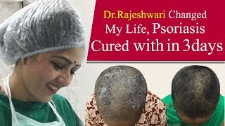 How To Cure Scalp Psoriasis Instantly  Dr Rajeshwaris Health Care [upl. by Ellegna]