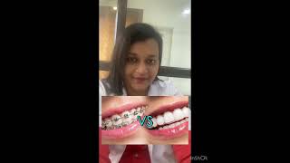 Braces or Aligners How to choose [upl. by Yeclek983]