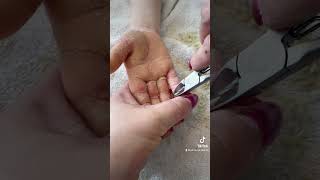 Removing callus from kid hands  Keratoderma hyperkeratosis EPPK skin shaving callous  Mar 30 2023 [upl. by Myles96]