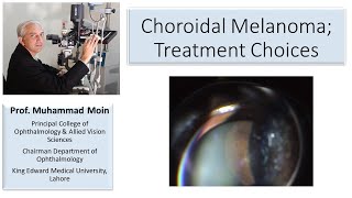 Choroidal Melanoma Treatment Choices [upl. by Obau]