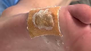 Plantar warts with treatment and root pulling it out  Nosa Niu [upl. by Nimad]