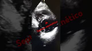 ANTEROSEPTAL FACE INFARCTION echocardiogram infarto anteroseptal [upl. by Nilesoy]