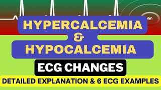 Hypercalcemia and Hypocalcemia ECG changes with 6 Examples Mechanism and Detailed Explanation [upl. by Yelyac]