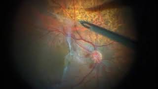 Vitreomacular Traction Syndrome amp Epiretinal Membrane [upl. by Gypsy]