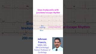 Sinus bradycardia with junctional escape rhythm [upl. by Guthrey220]