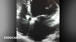 Vegetation on Pacemaker wire VS RA thrombus [upl. by Tamaru]