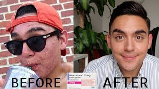 My Acne Journey ROACCUTANE [upl. by Suaeddaht]