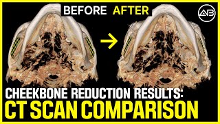 Cheekbone Reduction Surgery Explained with CT Scan  Before amp After  AB Plastic Surgery [upl. by Anitsej222]