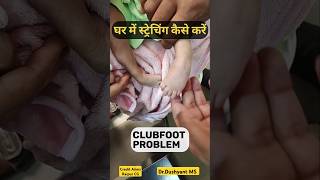 CLUBFOOT Streching at Home🔥 घर में कैसे करना है ctev clubfoot bowlegs [upl. by Utir]