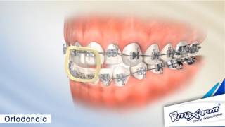 Corrección de mordida y espacios dentales quotOrtodonciaquot [upl. by Noillimaxam843]