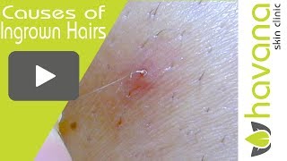 Ingrown Hair Removal Close Up  3 Main Causes of Ingrown Hairs [upl. by Htebsle]