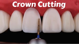 Crown Tooth Preparation Cutting for Anterior Incisor PFM Zirconia Ceramic Emax  Prostho Lecture [upl. by Erik596]