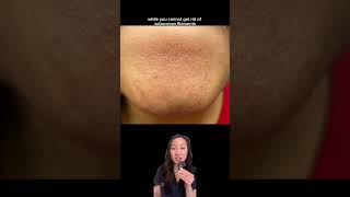 sebaceousfilaments blackheads comedones pores dermatologistskincare skincaretips derm [upl. by Ahseen]