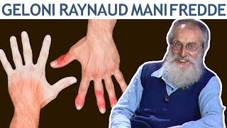 Dott Mozzi Geloni fenomeno di Raynaud mani e piedi freddi [upl. by Isla]