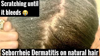 How to treat Seborrheic Dermatitis  Shampoo for DRY FLAKY scalp [upl. by Valentine110]