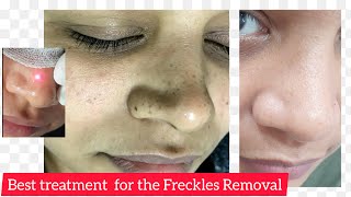 Best way to remove Freckles  LASER  Dr Anuj Pall MD PhD FISD USA [upl. by Laundes95]