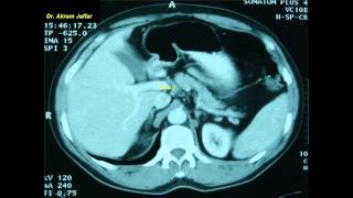 Cross sectional and imaging anatomy of the abdomen [upl. by Opal]