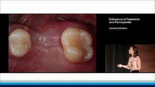 Enfoques en el Tratamiento de la Periimplantitis  Laurence Adriaens [upl. by Hobbs]