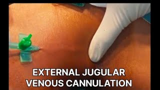 THIS IS HOW EXTERNAL JUGULAR VENOUS CANNULATION IS DONE [upl. by Pierpont]