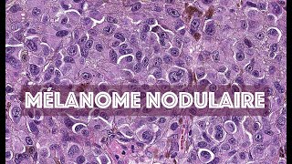 LE MELANOME NODULAIRE partie 2  PATHOLOGIE [upl. by Darrin931]