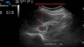 adenoma surrenalico sinistro [upl. by Naes]