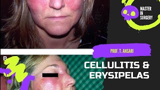 Everything You Need to Know About Cellulitis and erysipelas [upl. by Bluh612]