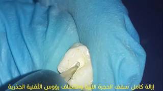 Pulpotomy in Extracted Primary Tooth [upl. by Holcman]