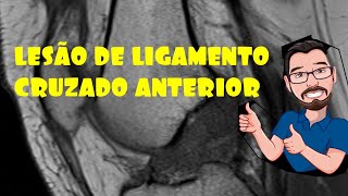 RUPTURA DE LIGAMENTO CRUZADO ANTERIOR RM [upl. by Elmaleh]