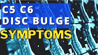 What Are The Symptoms Of A Bulging Disc In The Neck C5 C6 Disc Bulge Symptoms  Dr Walter Salubro [upl. by Anastasius]