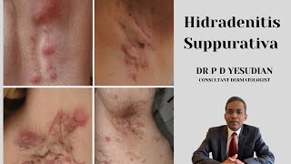 Hidradenitis suppurativa  pathogenesis and management [upl. by Ahael136]