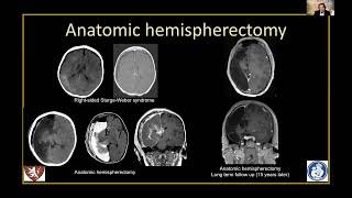 Imaging of hemispheric disconections S Prabhu [upl. by Stelle]