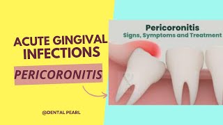 ACUTE GINGIVAL INFECTION PERICORONITIS [upl. by Adirehs]