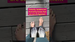 Correct your bunion bunions foothealth bunionrehab [upl. by Sharp]