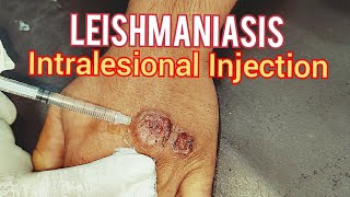 Leishmaniasis Treatment [upl. by Kilbride]