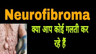 Neurofibroma treatment jagoindia1 neurofibroma lipoma lipomatreatment [upl. by Yrrok]