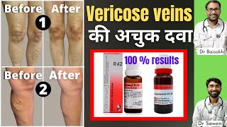 Homeopathic medicine for Varicose veins पैरों में उभरी हुई नीली नसें  Varicose veins treatment [upl. by Kappel]