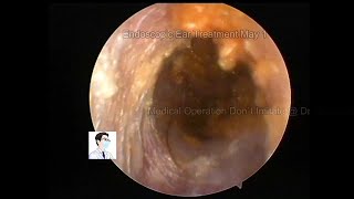 Ordinary EAR WAX and non absorbable ointment20230501 [upl. by Giliane783]