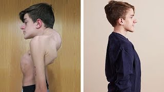 John Sarconas Testimonial  Overcoming Severe Scoliosis and Kyphosis [upl. by Rehoptsirhc]