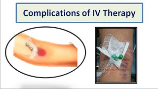 Complications of IV Therapy [upl. by Bellanca]