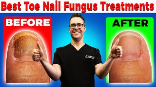 Best Toe Nail Fungus Treatments Onychomycosis Remedies [upl. by Jumbala521]