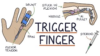 Understanding Trigger Finger Stenosing Tenosynovitis [upl. by Damales762]