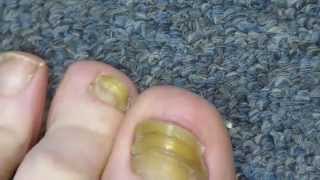 My Toenail Fungus Sucess Story [upl. by Ammamaria]