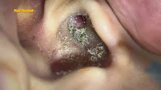 OMG It takes a long time to clean earwax 耳掃除 AsmrMinh MenHair lấy ráy tai [upl. by Jt]