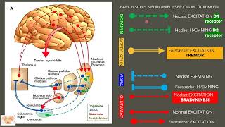 Challenges with Parkinsons disease [upl. by Alilad]