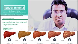 Stages of Chronic Liver Disease or Cirrhosis [upl. by Ecinna]